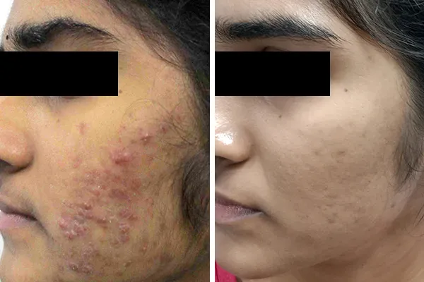 Hydrafacial Treatment